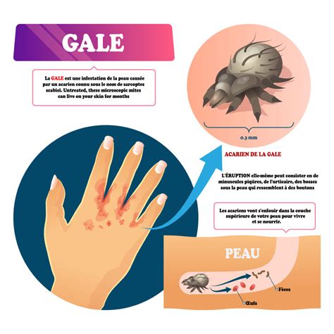 gale humaine.
